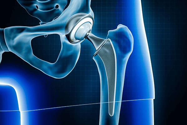 Combien De Temps Dure Une Prothèse De Hanche Prothèse totale de hanche par voie antérieure