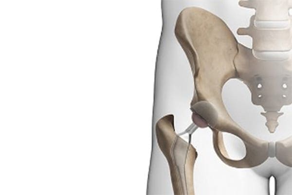type de prothese de hanche dr thomas xavier haen chirurgien specialiste orthopediste et traumatologue chirurgie orthopedique paris
