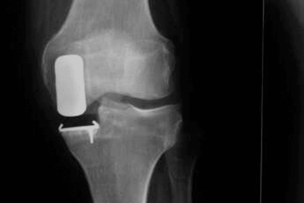 prothese partielle unicompartimentale genou docteur thomas xavier haen chirurgien hanche genou orthopediste paris