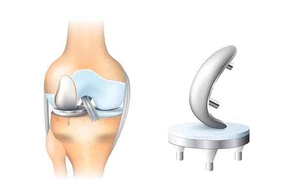prothese unicompartimentale de genou dr thomas xavier haen chirurgien specialiste orthopediste et traumatologue chirurgie orthopedique paris