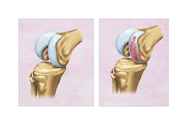usure du cartilage genou dr thomas xavier haen chirurgien specialiste orthopediste et traumatologue chirurgie orthopedique paris