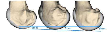 prothese genoux prix dr thomas xavier haen chirurgien specialiste orthopediste et traumatologue chirurgie orthopedique paris