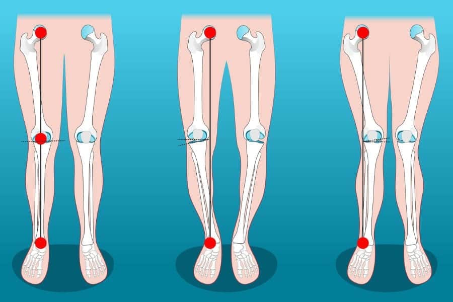 sport apres prothese genou docteur thomas xavier haen chirurgien specialiste orthopediste et traumatologue chirurgie orthopedique paris