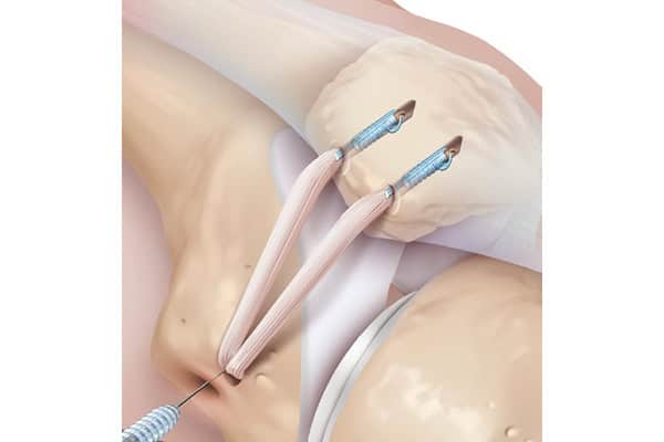 luxation rotule dr thomas xavier haen chirurgien specialiste orthopediste traumatologue hanche genou chirurgie orthopedique paris luxation rotule dr thomas xavier haen chirurgien specialiste orthopediste traumatologue hanche genou chirurgie orthopedique paris