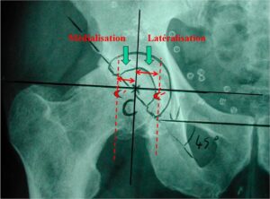 lateralisation prothese de hanche docteur thomas xavier haen chirurgien orthopedique hanche et genou paris