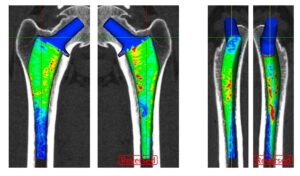 prothese de hanche moderne lateralisation prothese de hanche docteur thomas xavier haen chirurgien orthopedique hanche et genou paris