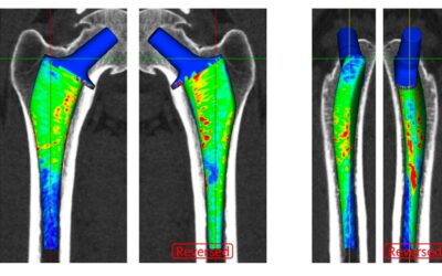 Techniques modernes de pose de prothèse de hanche