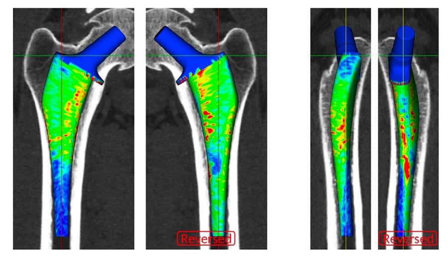 prothese de hanche moderne lateralisation prothese de hanche docteur thomas xavier haen chirurgien orthopedique hanche et genou paris