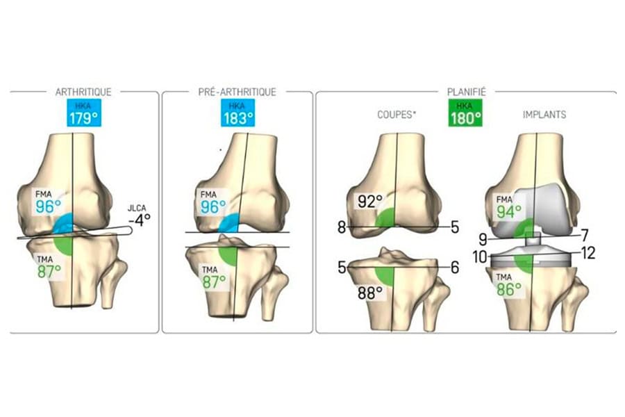 prothese de genou sur mesure docteur thomas xavier haen chirurgien specialiste orthopediste et traumatologue chirurgie orthopedique paris